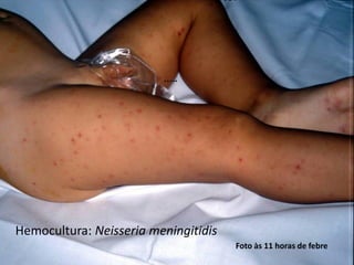 …..
Foto às 11 horas de febre
Hemocultura: Neisseria meningitidis
 