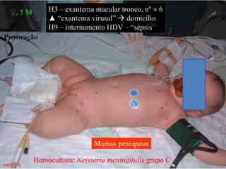♀, 5 M H3 – exantema macular tronco, nº  6
▲ “exantema virusal”  domicílio
H9 – internamento HDV – “sépsis”
04007250
Hemocultura: Neisseria meningitidis grupo C
Muitas petéquias
Prostração
 
