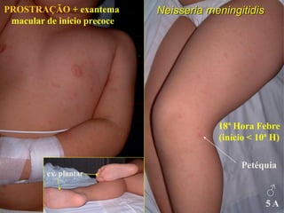 Petéquia
Neisseria meningitidis
18ª Hora Febre
(início < 10ª H)
♂
5 A
PROSTRAÇÃO + exantema
macular de início precoce
ex. plantar
 