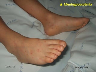 03003565
▲ Meningococcémia
06 Abril 2008
 