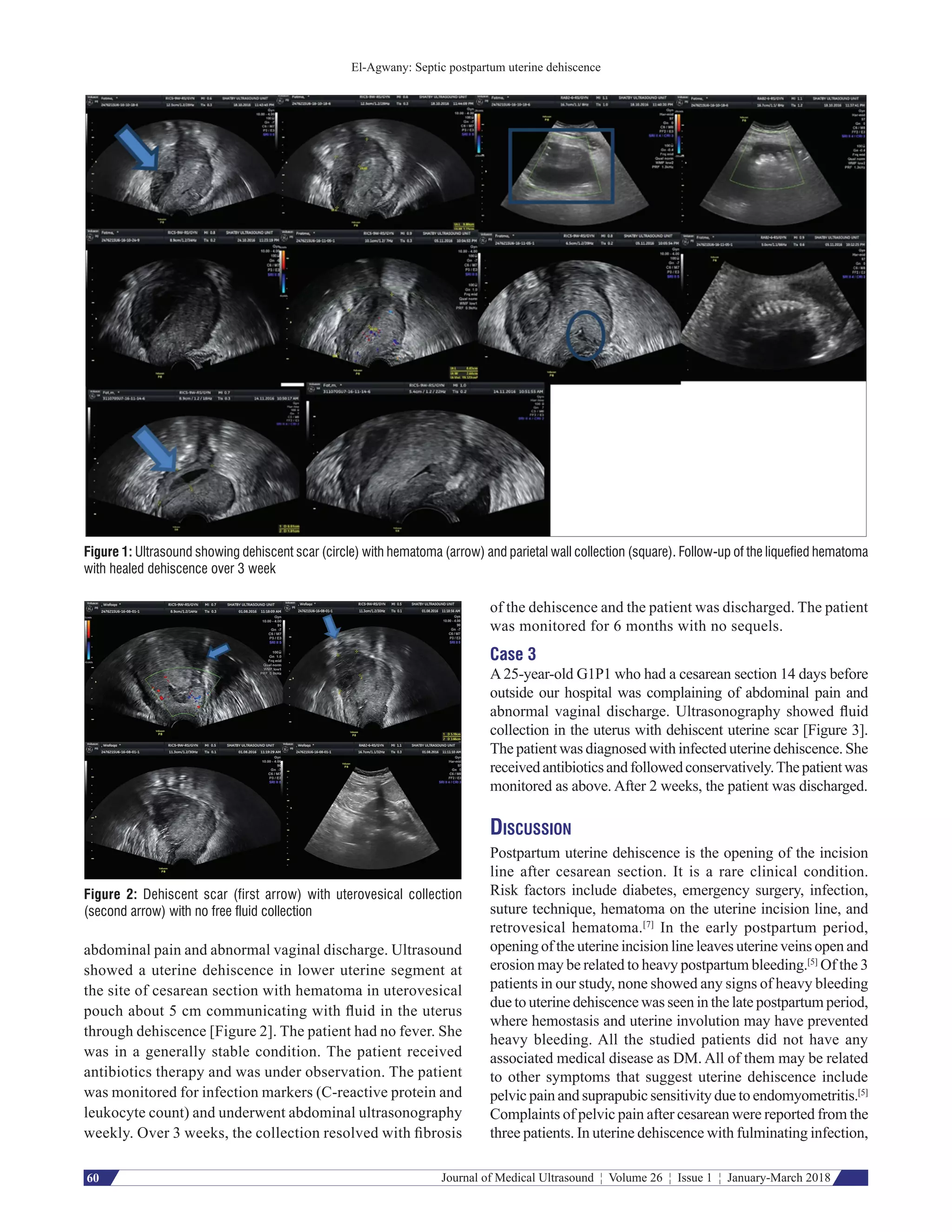 Infected cesarean section scar | PDF | Pregnancy | Reproductive Health
