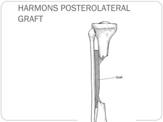 HARMONS POSTEROLATERAL
GRAFT
 