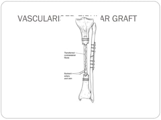 VASCULARISED FIBULAR GRAFT
 