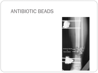 ANTIBIOTIC BEADS
 