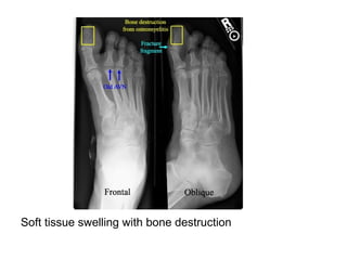 Diagnostic Imaging of Bone Infection | PPT