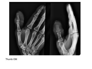 Diagnostic Imaging of Bone Infection | PPT