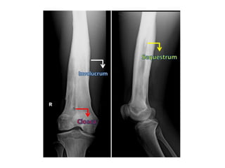 Diagnostic Imaging of Bone Infection | PPT