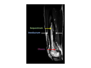 Diagnostic Imaging of Bone Infection | PPT