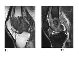 Diagnostic Imaging of Bone Infection | PPT