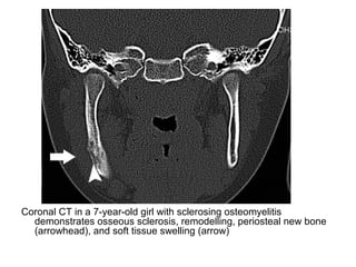Diagnostic Imaging of Bone Infection | PPT