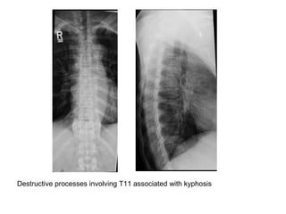 Diagnostic Imaging of Bone Infection | PPT