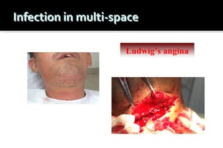 Ludwig’s angina

 