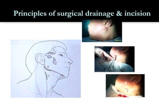 Principles of surgical drainage & incision

 