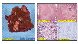 Caseation Hitopath INFECTIONS COMMON BACTERIAL VIRAL AND PARASITIC INFECTIONS-UG FINAL.pptx