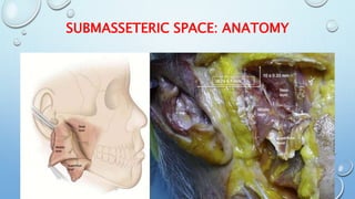 Submasseter Space Infection 2 | PPTX
