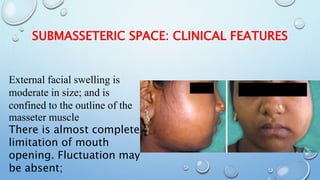 Submasseter Space Infection 2 | PPTX