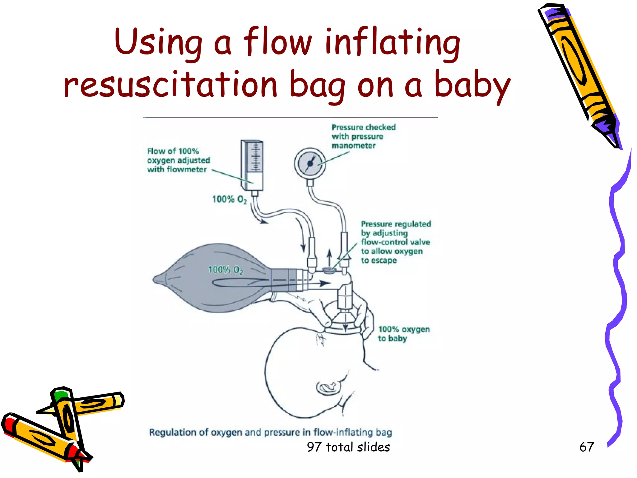 97 total slides 67
Using a flow inflating
resuscitation bag on a baby
 