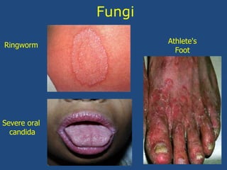 Fungi
Severe oral
candida
Ringworm
Athlete's
Foot
 