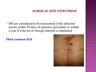  SSI are considered to be nosocomial if the infection
occurs within 30 days of operative procedure or within
a year if a device or foreign material is implanted
Third common HAI
 
