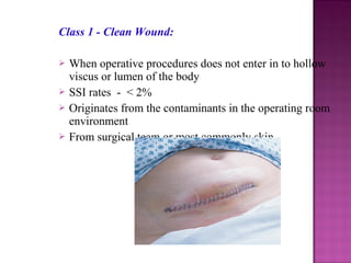 Class 1 - Clean Wound:
 When operative procedures does not enter in to hollow
viscus or lumen of the body
 SSI rates - < 2%
 Originates from the contaminants in the operating room
environment
 From surgical team or most commonly skin
 