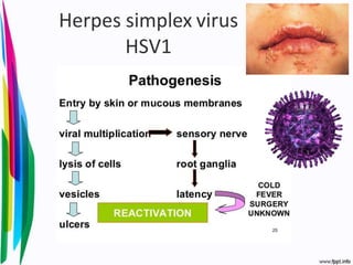 Herpes simplex virus
HSV1
 