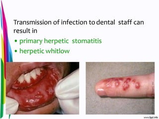 Transmission of infection todental staff can
result in
• primary herpetic stomatitis
• herpetic whitlow
 