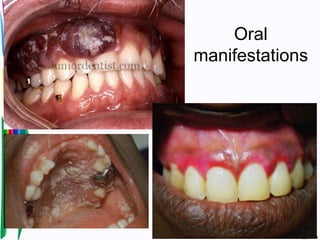 Oral
manifestations
 