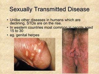 Sexually Transmitted Disease Unlike other diseases in humans which are declining, STDs are on the rise. In western countries most common in people aged 15 to 30 eg. genital herpes 