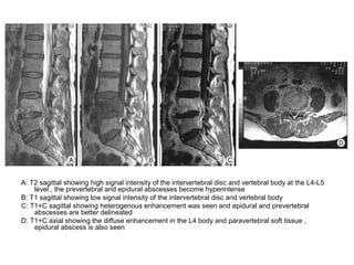 Diagnostic Imaging of Spinal Infection & Inflammation | PPT