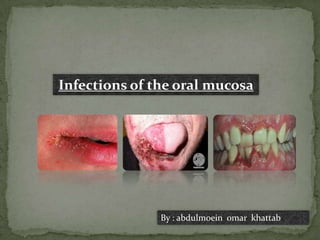 Infections of the oral mucosa




               By : abdulmoein omar khattab
 
