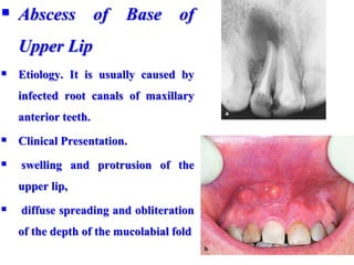  Abscess of Base of
Upper Lip
 Etiology. It is usually caused by
infected root canals of maxillary
anterior teeth.
 Clinical Presentation.
 swelling and protrusion of the
upper lip,
 diffuse spreading and obliteration
of the depth of the mucolabial fold
 