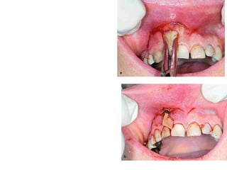 Treatment
• incision for drainage:
• is made at the mucolabial fold parallel to
the alveolar process.
•A hemostat is then inserted inside the
cavity, which reaches bone, aiming for the
apex of the responsible tooth, facilitating
the evacuation of pus.
•A rubber drain is placed until the clinical
symptoms of the infection subside .
 