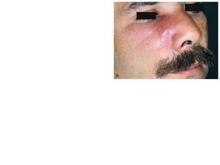 •Canine Space infection
•Clinical Presentation.
This is characterized :
edema localized in the infraorbital region,
• obliteration of the nasolabial fold and
somewhat of the mucolabial fold.
•the skin becomes taut and shiny due to
suppuration, while its color is reddish
 