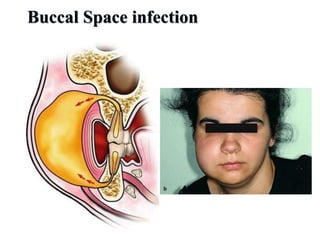 Buccal Space infection
 