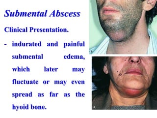 Submental Abscess
Clinical Presentation.
- indurated and painful
submental edema,
which later may
fluctuate or may even
spread as far as the
hyoid bone.
 