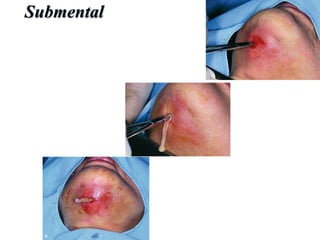 Submental Abscess
 