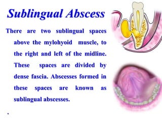 Sublingual Abscess
There are two sublingual spaces
above the mylohyoid muscle, to
the right and left of the midline.
These spaces are divided by
dense fascia. Abscesses formed in
these spaces are known as
sublingual abscesses.
.
 