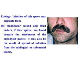 Etiology. Infection of this space may
originate from
the mandibular second and third
molars, if their apices are found
beneath the attachment of the
mylohyoid muscle. It may also be
the result of spread of infection
from the sublingual or submental
spaces.
Sub-mandibular Abscess
 