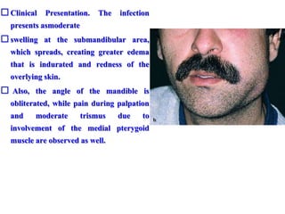  Clinical Presentation. The infection
presents asmoderate
 swelling at the submandibular area,
which spreads, creating greater edema
that is indurated and redness of the
overlying skin.
 Also, the angle of the mandible is
obliterated, while pain during palpation
and moderate trismus due to
involvement of the medial pterygoid
muscle are observed as well.
 