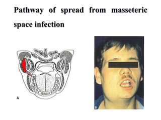 Pathway of spread from masseteric
space infection
 