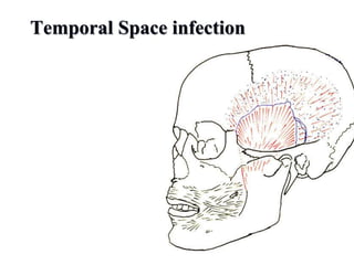 Temporal Space infection
Clinical Presentation. It is
characterized by painful edema of
the temporal fascia, trismus (the
temporalis and medial pterygoid
muscles are involved), and pain
during palpation of the edema.
 
