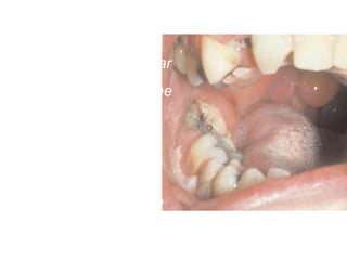 Right pterygomandibular
space abscess. Note the
swelling of the anterior
tonsillar pillar and the
deviation of the
edematous uvula to the
opposite side.
 