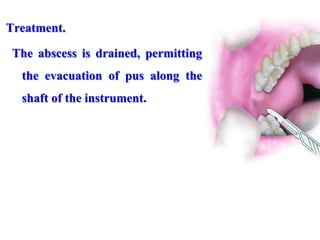 Treatment.
The abscess is drained, permitting
the evacuation of pus along the
shaft of the instrument.
 