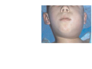 Left lateral pharyngeal space
abscess. Note the swelling just
anterior to the sternocleidomastoid
muscle above the level of the hyoid
bone and the deviation of the head
toward the right shoulder, in an
attempt to place the upper airway
directly over the deviated trachea
 