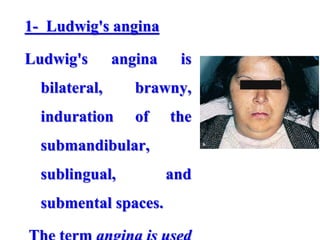 1- Ludwig's angina
Ludwig's angina is
bilateral, brawny,
induration of the
submandibular,
sublingual, and
submental spaces.
 