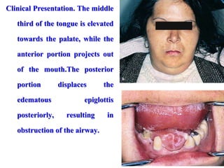 Clinical Presentation. The middle
third of the tongue is elevated
towards the palate, while the
anterior portion projects out
of the mouth.The posterior
portion displaces the
edematous epiglottis
posteriorly, resulting in
obstruction of the airway.
 