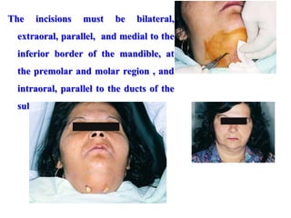 The incisions must be bilateral,
extraoral, parallel, and medial to the
inferior border of the mandible, at
the premolar and molar region , and
intraoral, parallel to the ducts of the
submandibular glands.
 