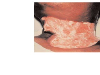 Necrotizing
fasciitis. Large
granulating skin
defect
extending from
the inferior
border of the
mandible to the
clavicle, 2
weeks
After
débridement.
 