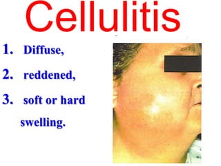 1. Diffuse,
2. reddened,
3. soft or hard
swelling.
Cellulitis
 