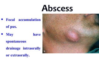 Abscess
 Focal accumulation
of pus.
 May have
spontaneous
drainage intraorally
or extraorally.
 